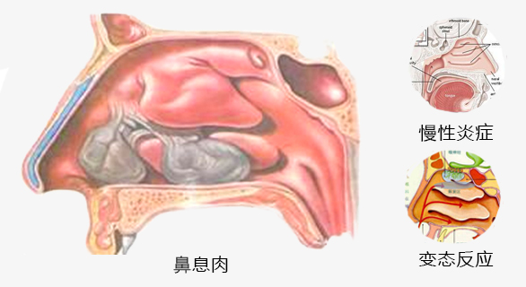 鼻息肉解剖图